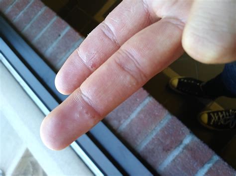 Tiny Red Bumps Under Skin On Fingers at Eric Rodriguez blog