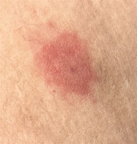 Tick bite : r/medical_advice