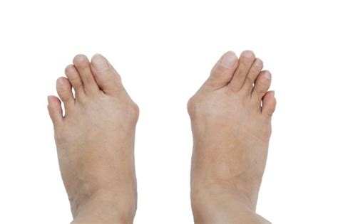 Gout vs. Bunion - The Difference Between Gout and Bunion