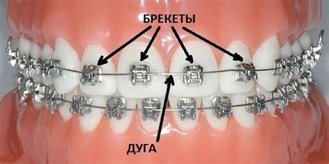Разъезжаются зубы после снятия брекетов