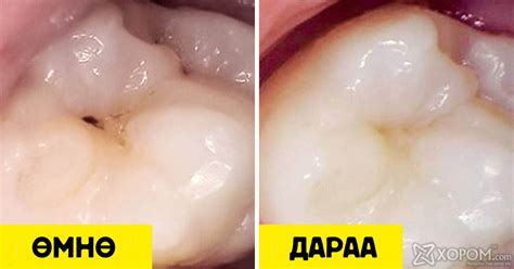 Шүдний эмч нар шүд цоорохоос урьдчилан сэргийлэхэд туслах 10 энгийн ...