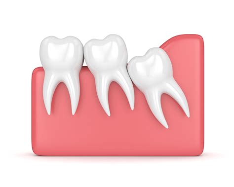 Wisdom Tooth Extraction: Before, During, After | Fort Worth Oral Surgeon