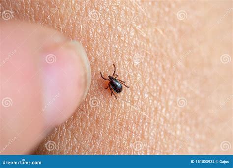 Tick On Human Skin On The Background Of The Forest Royalty-Free Stock ...