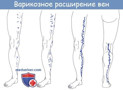 Анатомия: Вены нижней конечности (ноги). Глубокие и поверхностные вены ноги