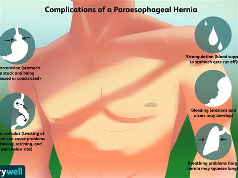 Hiatal hernia pain in chest and back. Hiatal Hernia: Causes, Symptoms