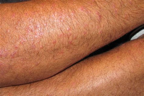 Food Poisoning Symptoms Skin Rash