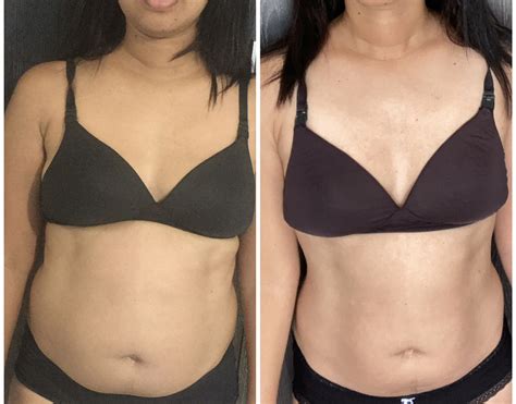 How to Identify PCOS Belly: Signs & Causes You Must Know