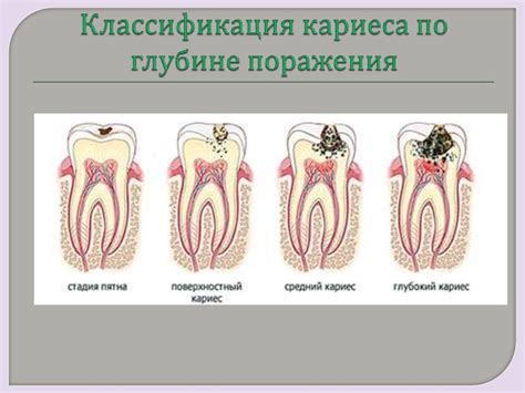 Кариес зуба - презентация онлайн