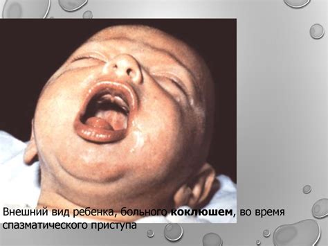 Коклюш. Морфология - презентация онлайн