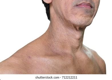 Skin Lesion Crusting Images, Stock Photos & Vectors | Shutterstock