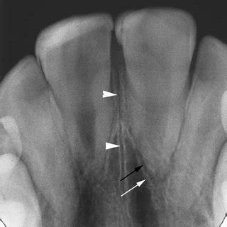 -Dentigerous cyst. A, A panoramic radiograph shows a large ...