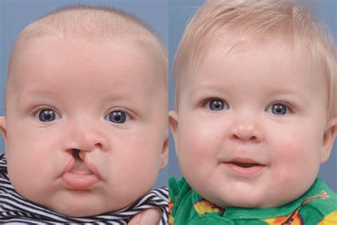 Bilateral Cleft Lip And Palate Before And After at Loretta Little blog