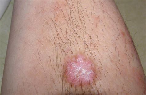 Clear Cell Acanthoma