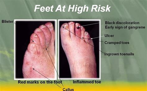 Diabetic toes pictures 1 | Symptoms and pictures