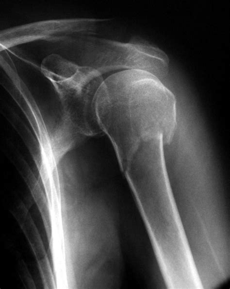 Treatment of Humerus fractures – Medical Pharma News | Modern health ...