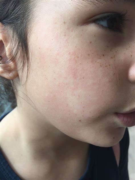 Eczema On Face