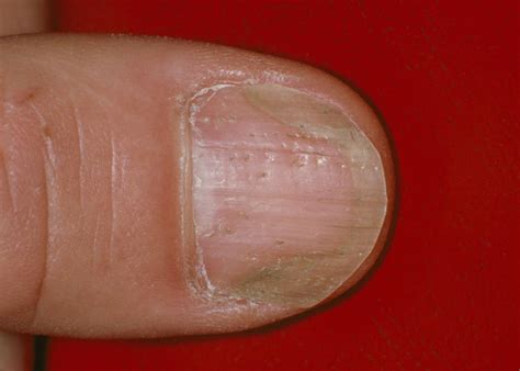 Subungual Hyperkeratosis