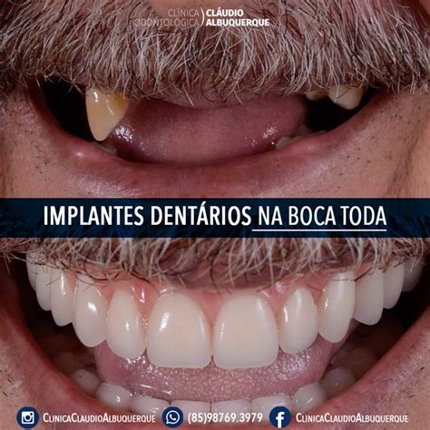 Implante De Todos Os Dentes Valor - Implante dentário na Boca Toda | Implantes de Dentes em todos os dentes
