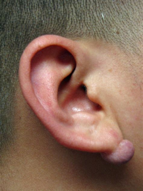 Earlobe Keloid Second Patient: Keloid On The Left Ear Lobe After Three