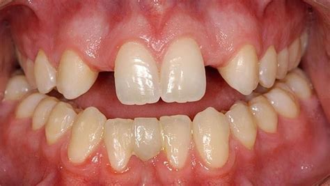 Agenesia - Definition of Agenesia