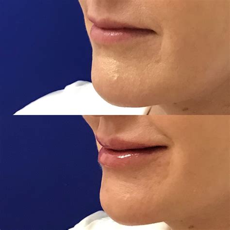 restylane lip filler 10