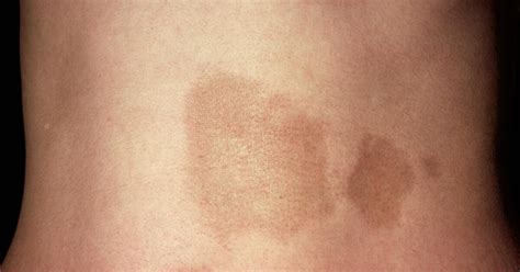 morphea symptoms  treatment types  morphea