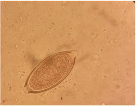 Trichuris vulpis egg. Fecal flotation, magnification x100. | Download ...
