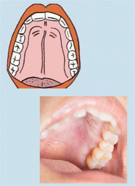 Oral Cancer Roof Of Mouth