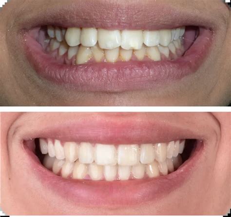 Clear aligners Before & After: Our Patients Speak For Us | Eon Aligner