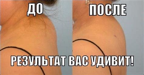 КАК ИЗБАВИТЬСЯ ОТ ХОЛКИ НА ШЕЕ! После нескольких процедур шея вновь ...