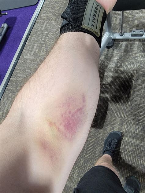 Can I Exercise After Blood Work? How Long Should You Wait?