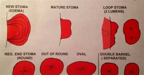Different Types Of Ostomies I Had An Ileostomy Nursin - vrogue.co