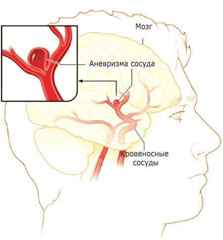 Аневризма головного мозга: симптомы, лечение, последствия после операции