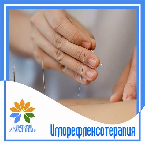 Иглорефлексотерапия