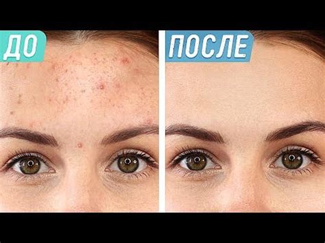 Как в домашних условиях избавиться от прыщей на лице