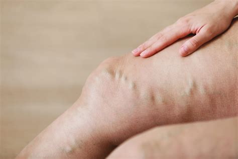 Varicose Veins - NEXGEN Orthopedic Health & Wellness