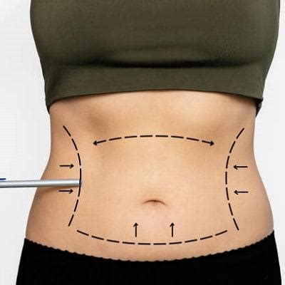 how old do you have to be to get liposuction