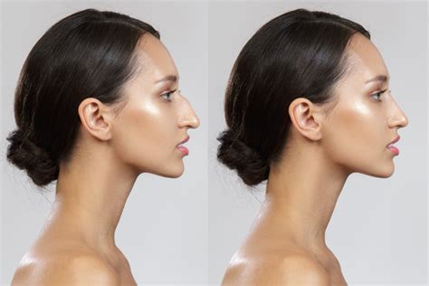 O'que É Rinoplastia - Rinoplastia: definição, tipos e como é feita - Clínica Clincer