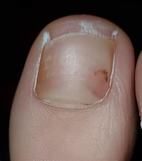 Spot on inside of big toenail. I noticed it about 2 weeks ago, it may