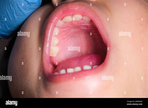 Soft palate mouth hi-res stock photography and images - Alamy