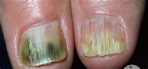ONICOMICOSIS(HONGOS EN LAS UÑAS)-TODO SOBRE SALUD Y ENFERMEDADES : TODO ...