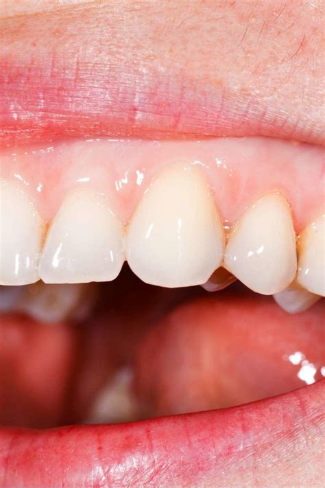 white ps  gums  infoupdateorg