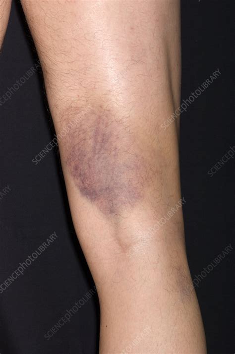 Bruised leg - Stock Image - M330/1530 - Science Photo Library