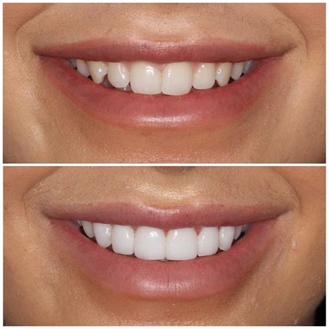 natural  veneers  veneers sydney