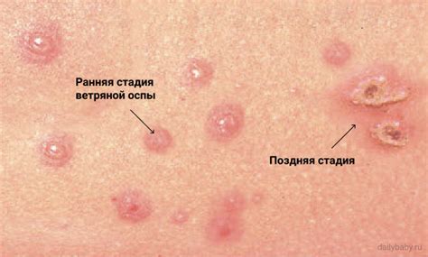 Виды детской сыпи: памятка-инструкция для родителей