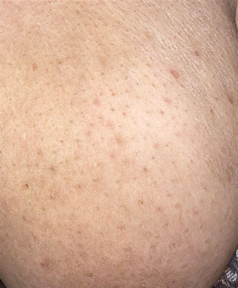 Black Marks Under Breast at Harvey Horton blog