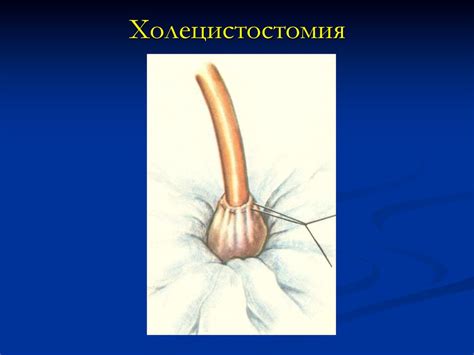 Желчнокаменная болезнь - презентация онлайн