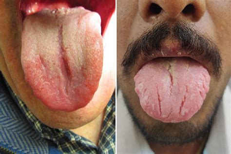 Psoriasis On Lips Symptoms - Infoupdate.org