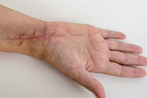 scar revision  plasty  plasty   techniques