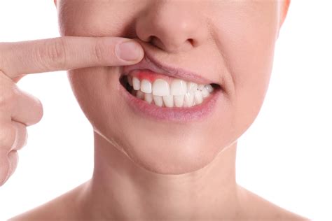 Gum Disease Linked To Cancer | NaturalHealth365